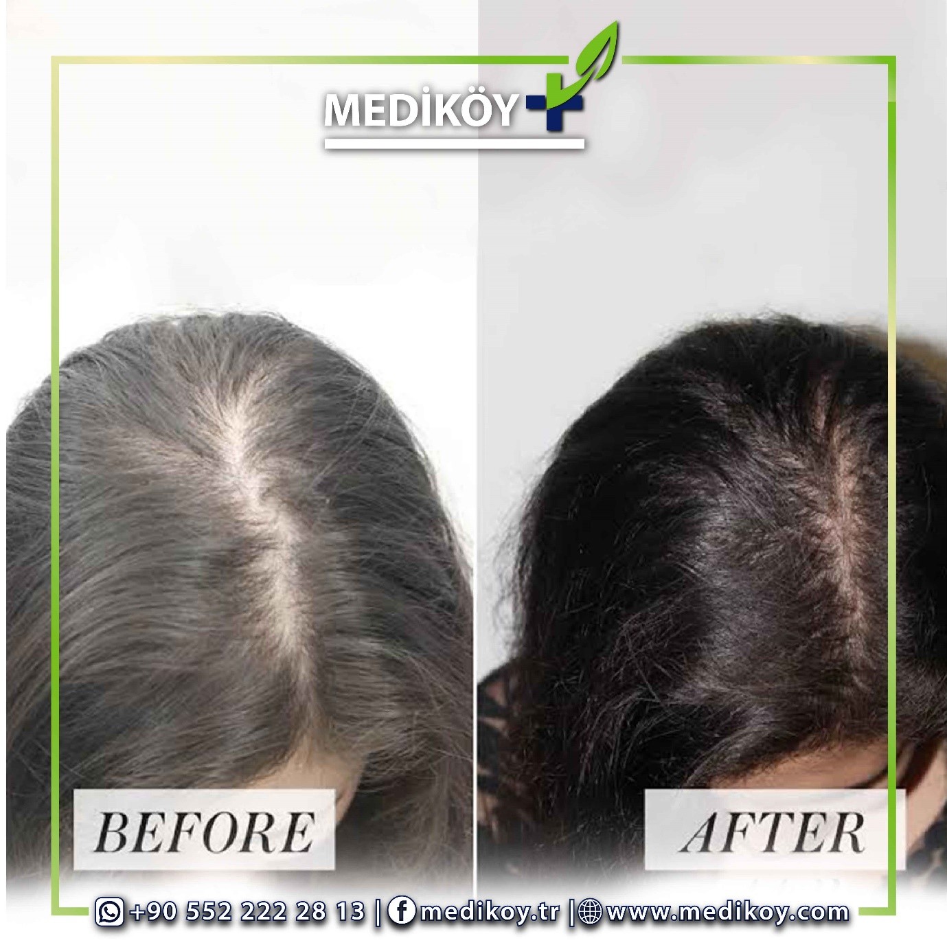FEMALE HAIR TRANSPLANT IN TURKEY Best Hair Transplant in Turkey