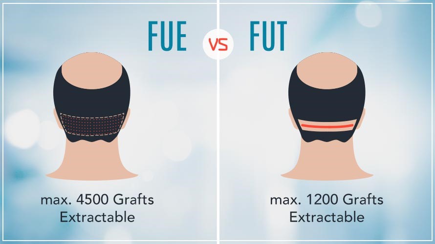 FUT Vs FUE Medikoy for hair transplant