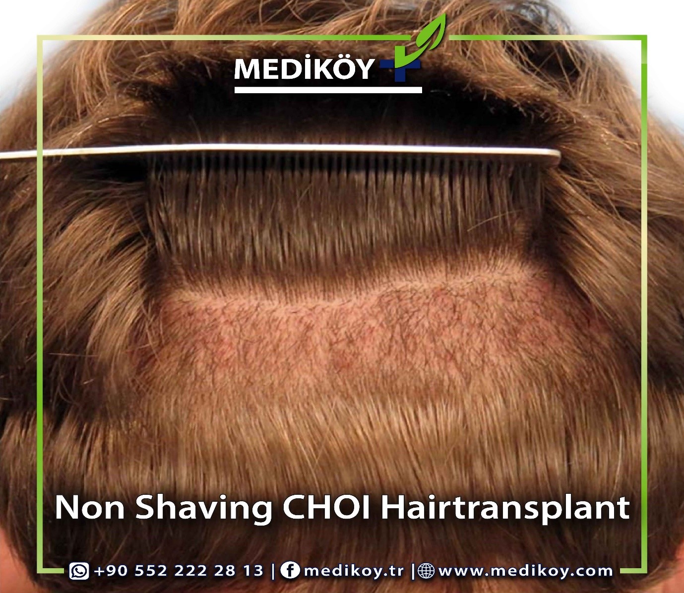 Female Hair Transplant in Delhi  Women Hair Transplant cost in India  DermaClinix