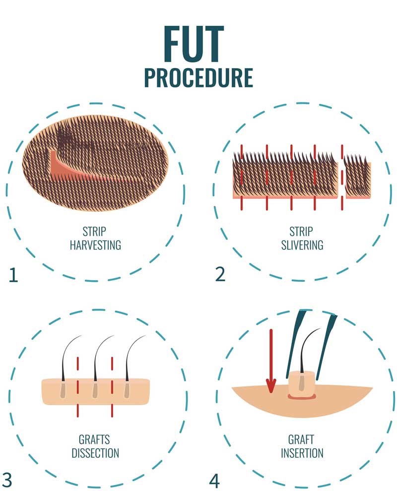 FUT Medikoy for hair transplant