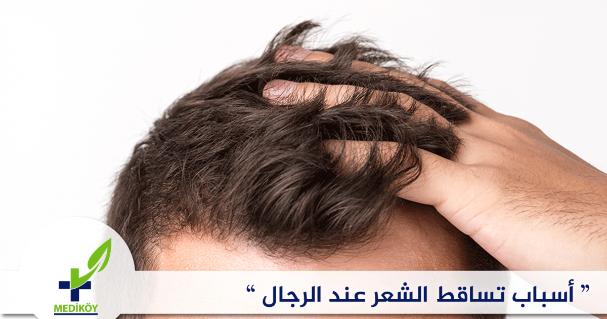 أسباب تساقط الشعر عند الرجال