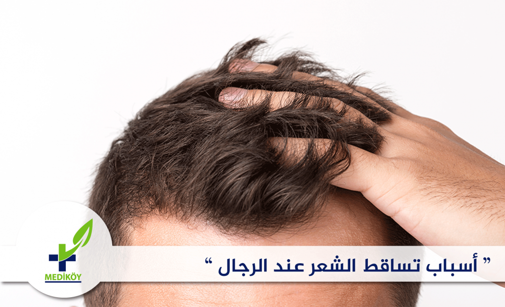 أسباب تساقط الشعر عند الرجال