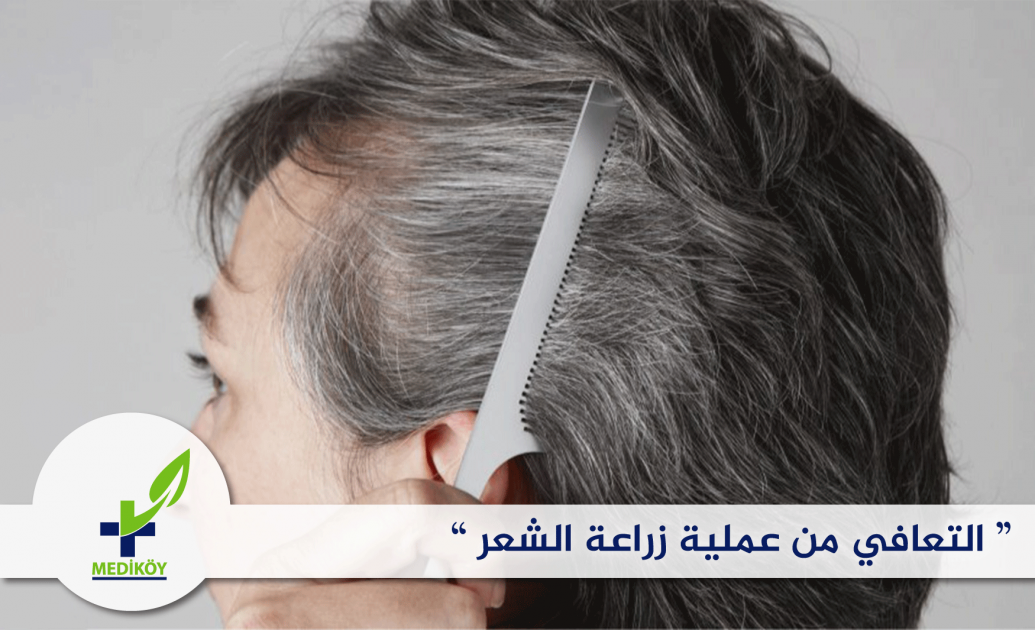 التعافي من عملية زراعة الشعر