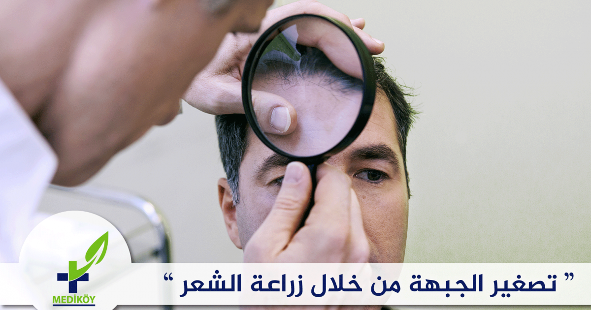 تصغير الجبهة من خلال زراعة الشعر