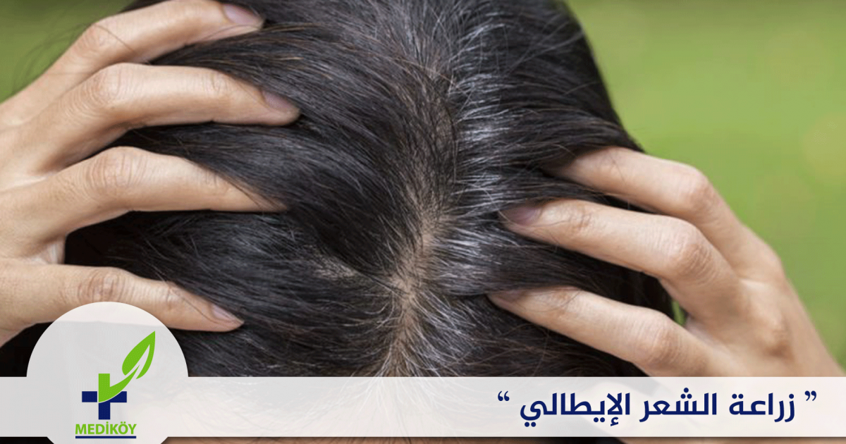 زراعة الشعر الإيطالي