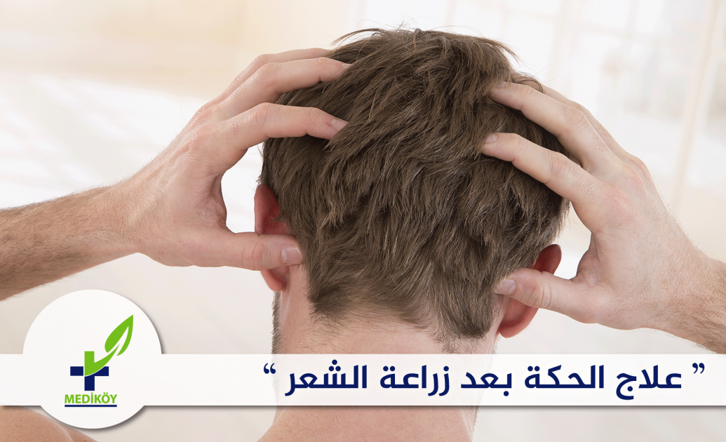 علاج الحكة بعد زراعة الشعر