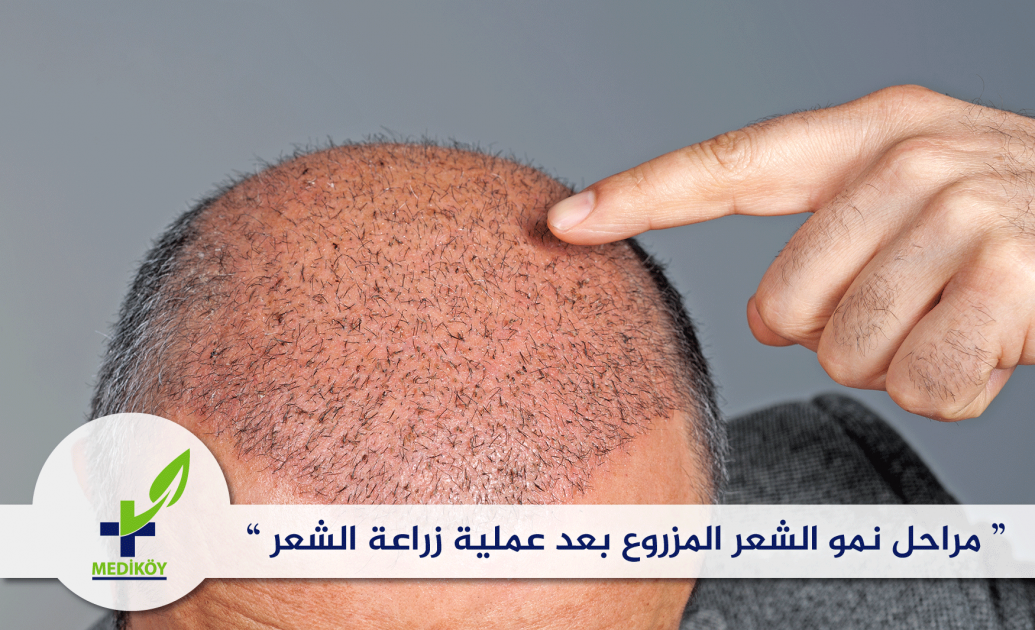 فيروس عرضة لل كفيل مدة نمو الشعر بعد الحلاقة عند الرجال balestron com