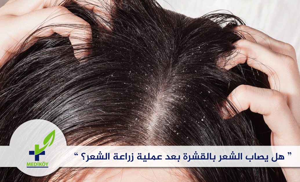 ظهور القشرة بعد عمليات زراعة الشعر