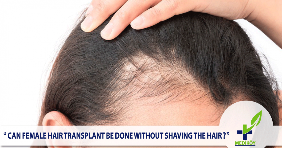 FEMALE HAIR TRANSPLANT BE DONE WITHOUT SHAVING THE HEIR