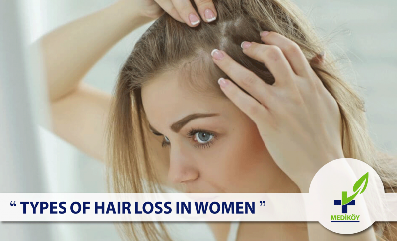 Women Hair Transplant